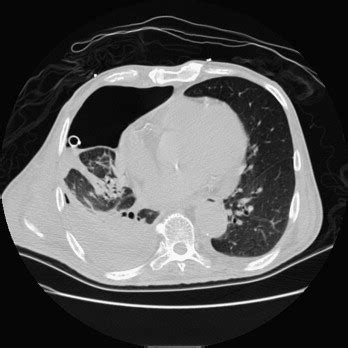 Tension Pyopneumothorax Resuscitation