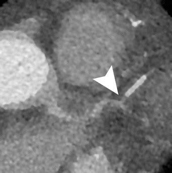 Multimodal Multiparametric Three Dimensional Image Fusion In Coronary