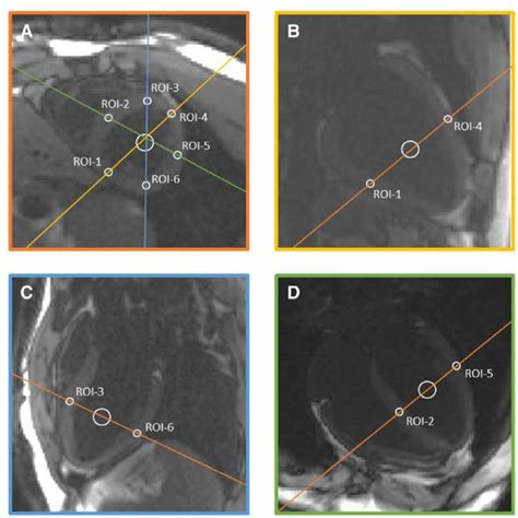 Myocardial T1 And T2 Mapping And Late Gadolinium Enhancement Lge