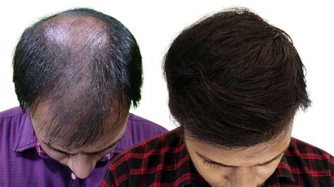 Hair Transplant Result Full Coverage And Density Grade 6 Baldness 5000 Grafts Implant