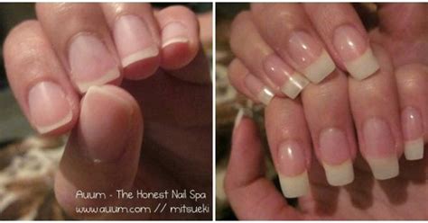 Claw Nails Disease Web Kreativitas