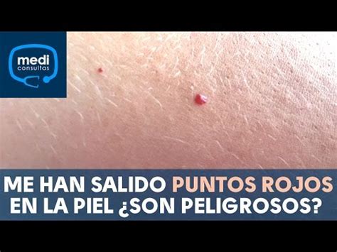 Puntos Rojos En Las Piernas Causas S Ntomas Y Tratamientos