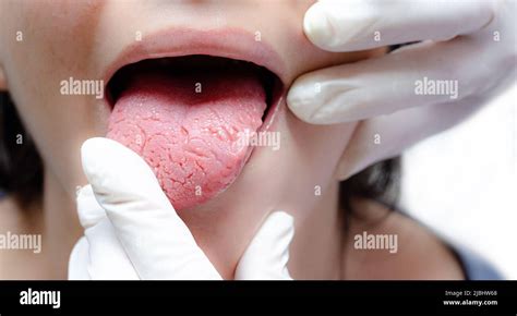 Tongue of a young Caucasian woman with benign migratory glossitis, held by a doctor wearing ...