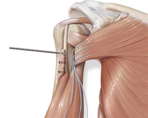 Expertise Pectoralis Major Tendon Repair Barden Orthopedics