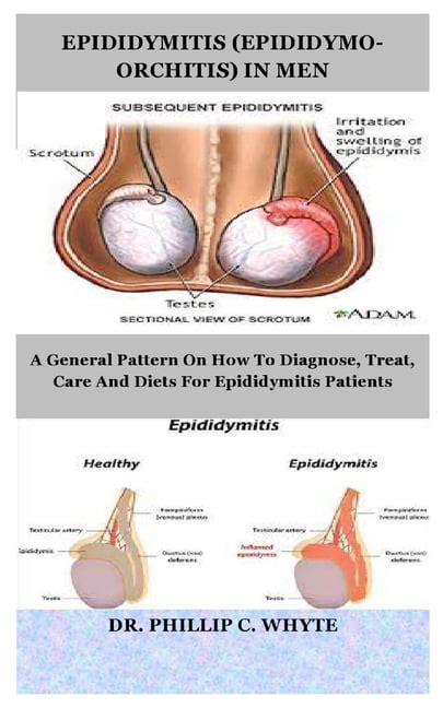 Epididymitis Epididymo Orchitis In Men A General Pattern On How To