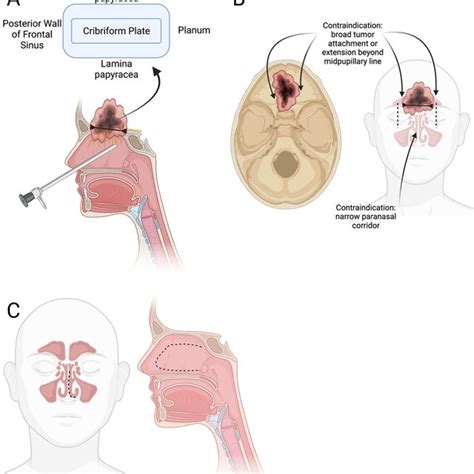 Endonasal Endoscopic Transcribriform Approach For Resection Of An