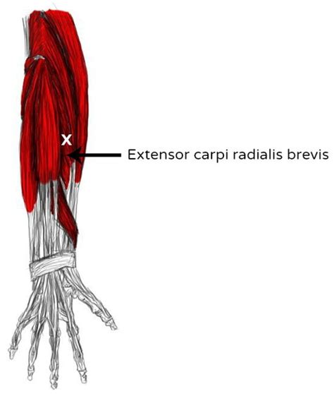 Extensor Carpi Radialis Brevis Tendon