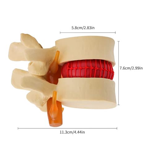 Buy Lvchen Disc Herniation Model Human Lumbar Disc Herniation Spine