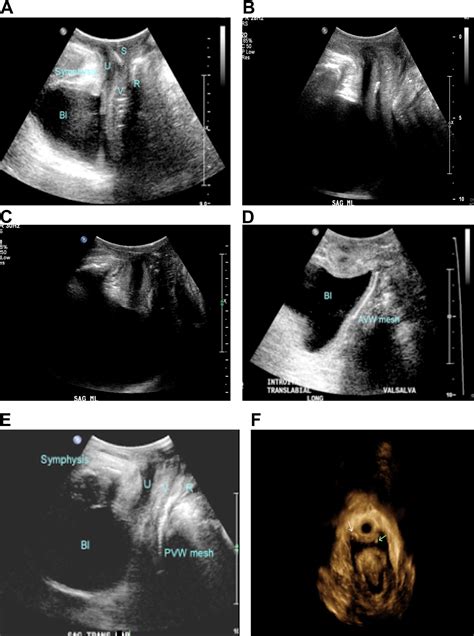 Translabial Ultrasonography For Evaluation Of Synthetic Mesh In The