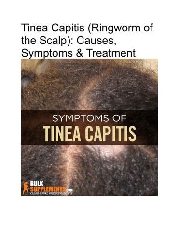 Tinea Capitis Ringworm Of The Scalp Causes Symptoms Treatment By