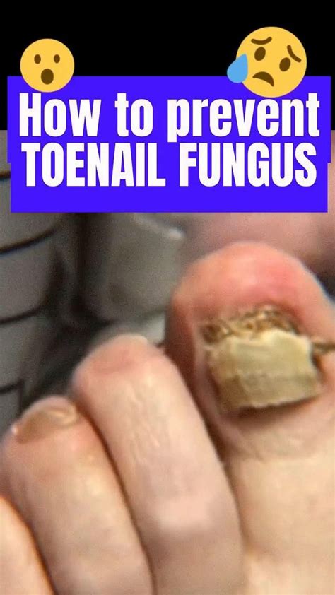 How To Prevent Toenail Fungus Artofit