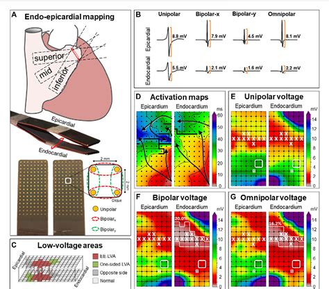 Figure 1 From Detection Of Endo Epicardial Atrial Low Voltage Areas