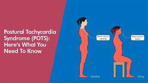 POSTURAL TACHYCARDIA SYNDROME POTS HERES WHAT YOU NEED TO KNOW