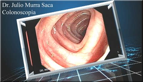 C Ncer Del Colon Gastroenterologia El Salvador Murrasaca