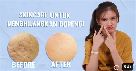 Ajaib Skincare Untuk Menghilangkan Bopeng Paling Efektif Dijamin