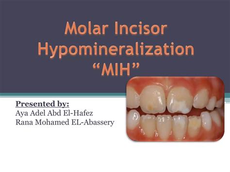 Molar Incisor Hypomineralization Ppt