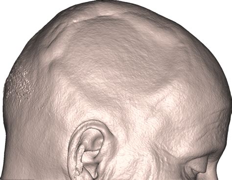 Skull Reconstruction After Meningioma Xilloc