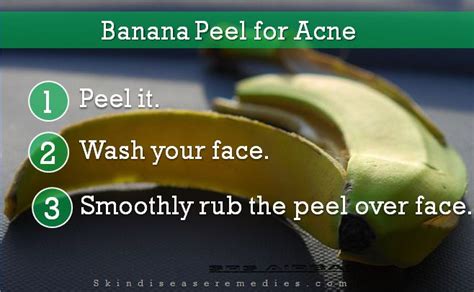 Banana Peel for Acne Treatment - Proven - Skin Disease Remedies