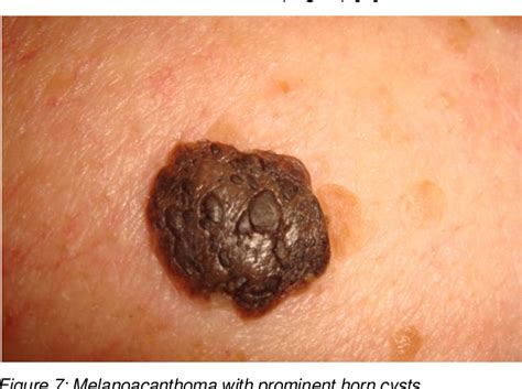 Figure 4 From Seborrheic Keratoses The Most Common Benign Skin Tumor