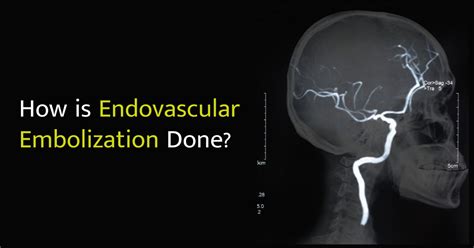 How Is Endovascular Embolization Done Sri Ramakrishna Hospital