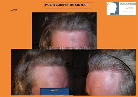 Dr Patrick Mwamba Hair Restoration Surgery Before And After