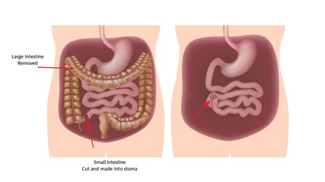 No More UC for Me: J-Pouch Surgery 101