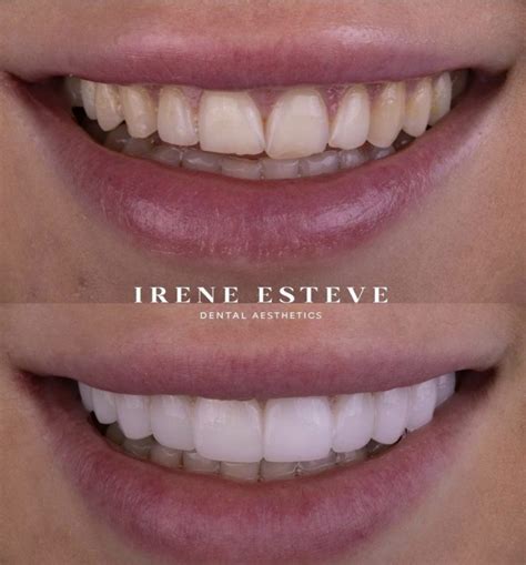 Qu Son Las Carillas Dentales Sin Tallado Irene Esteve