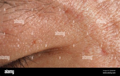 Wart Skin Removal Macro Shot Of Warts Near Eye On Face Papilloma On Skin Around Eye Nose And