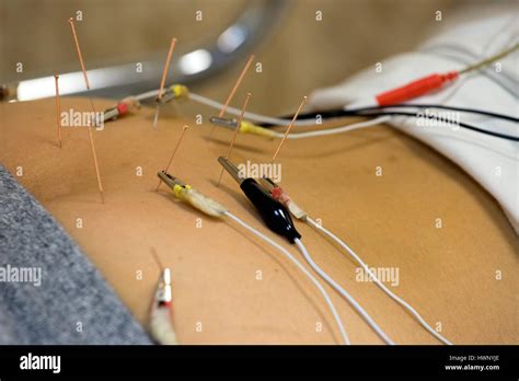 A Patient Receiving Electro Acupuncture Hong Kong China Stock Photo