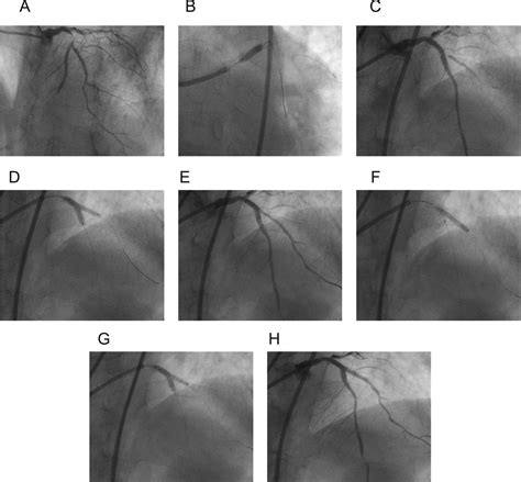 Recent Perspective On Coronary Artery Bifurcation Interventions Heart