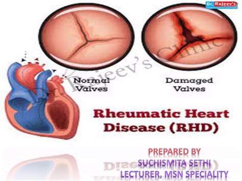 Rheumatoid Heart Disease Ppt