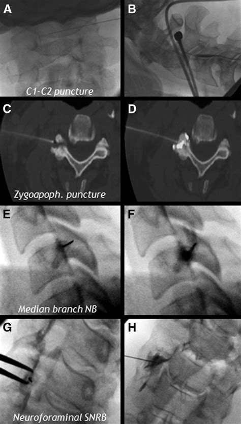 Lateral Approach C1 C2 Puncture A And B The Needle Is Inserted To