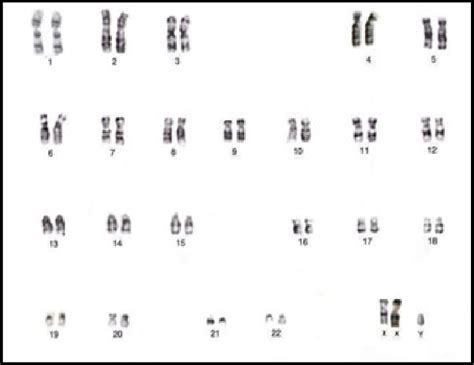 Klinefelter Syndrome Chromosome