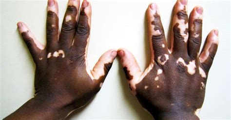 Vitiligo: Illustrated guide to pigmentation disorder