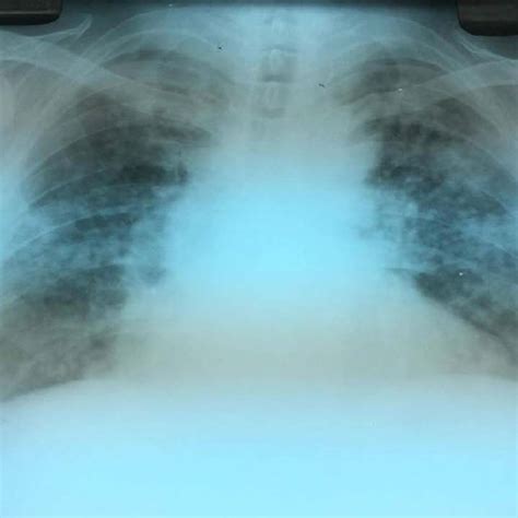 Chest X Ray Showing Silicosis Stage R Q B Ax With Several