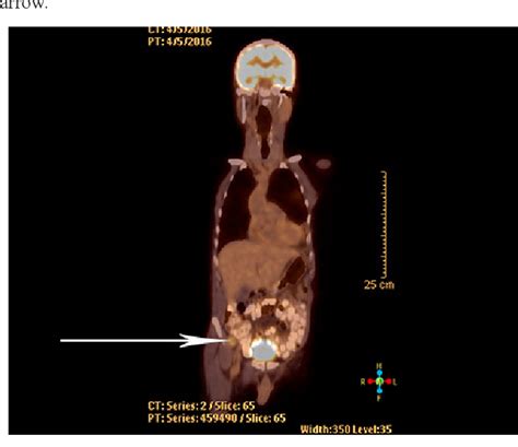 Retroperitoneal Ancient Schwannoma A Case Report And Review Of