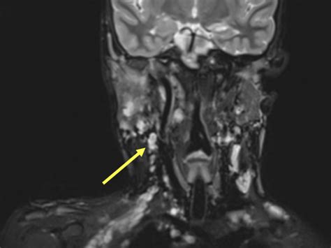 Neurofibromatosis Type Nf Mri Online