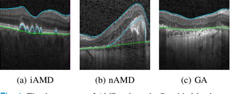 Figure 1 From Segmentation Of Bruch S Membrane In Retinal OCT With AMD