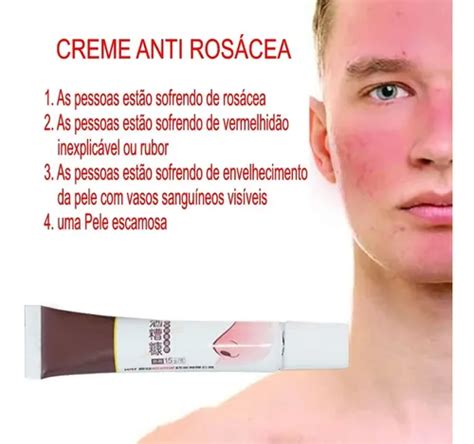Pomada Para Vermelhidão No Rosto - Pomada Creme Anti Rosácea Acne Rosácea Vermelhidão Importado | Frete grátis