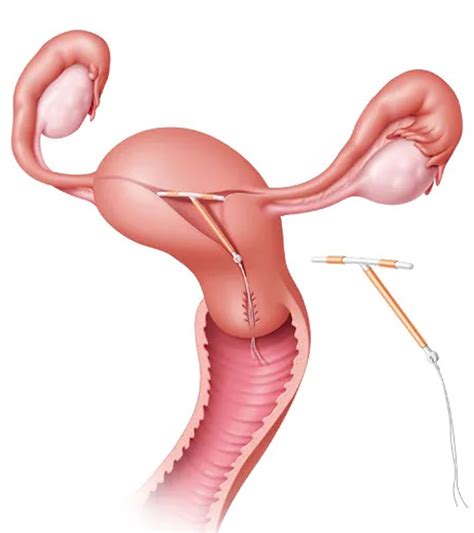 Iud Contraceptive Device Types Insertion Removal Risks And Side Effects