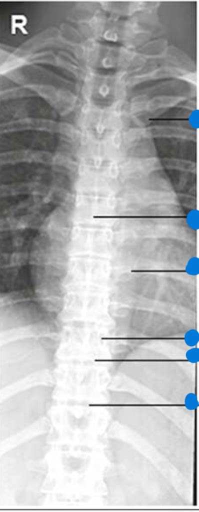 Ap T Spine Radiograph Diagram Quizlet