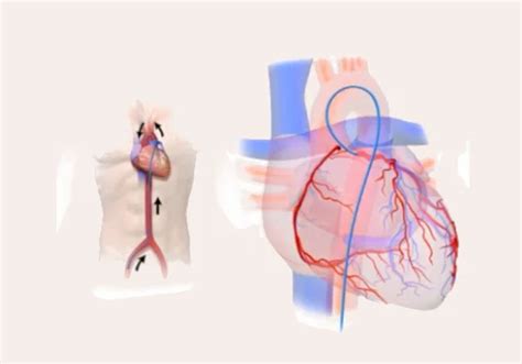 Top 5 Angiogram Risks for Diabetics