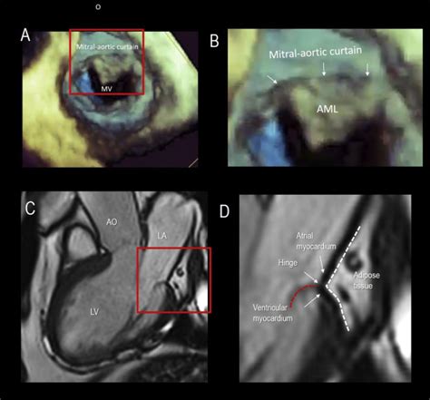 ECHOVAR ECO DEL DIA Disyuncion De Anillo Mitral Una Nueva Mirada