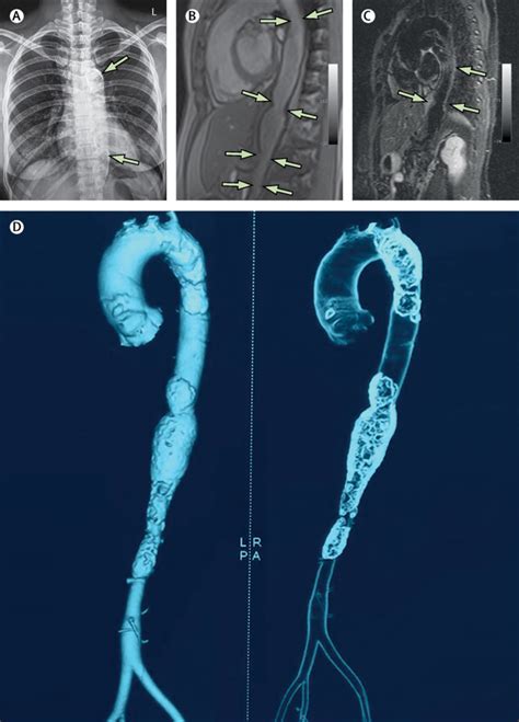 Aortic Calcification In Longstanding Undiagnosed Takayasu Arteritis