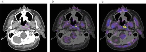 F Fluoromisonidazole And A New Pet System With Semiconductor