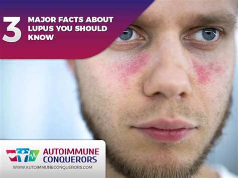 Autoimmune Conquerors Major Facts About Lupus You Should Know