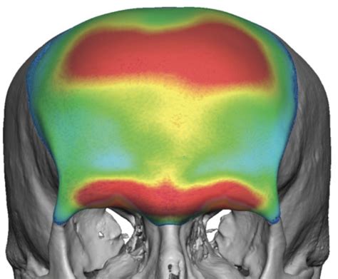 Custom Male Forehead Brow Bone Implant Thickness Front View Dr Barry Eppley Indianapolis