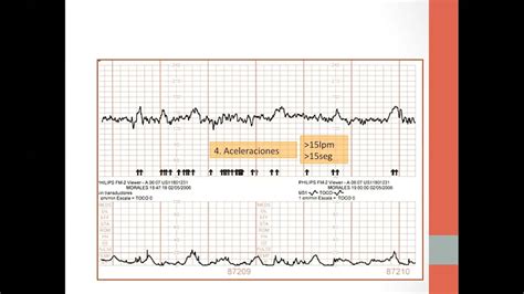 Interpretación del Monitoreo Fetal Intraparto y Resucitación