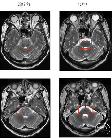 【疾病百科】放射性脑干损伤——早发现早治疗 脑医汇 神外资讯 神介资讯