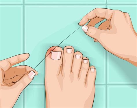 Ongle Incarné Nos Solutions Et Astuces